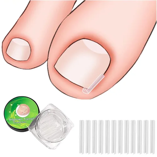 Vista 3 de (30+2) Kit de tratamiento de corrección de uñas encarnadas, 30 tiras correctoras de uñas encarnadas, herramienta de pedicura de uñas encarnadas