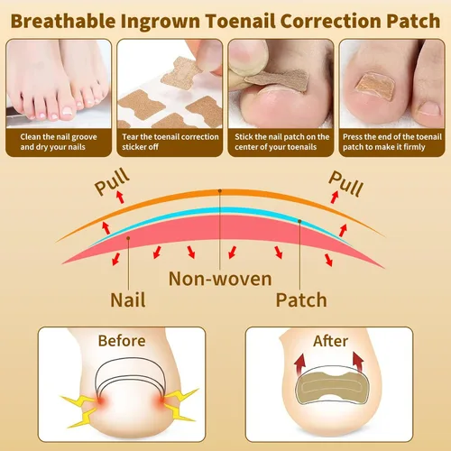 Vista 3 de Juego de corrector de uñas encarnadas con tiras correctoras y lima sin dolor, kit profesional de eliminación de uñas encarnadas con herramienta