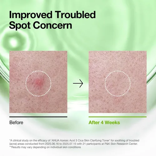 Vista 5 de Anua Tónico aclarante de ácido azelaico 3 CICA, tónico facial exfoliante diario con salicílico, para calmar y claridad de la piel, cuidado de sebo