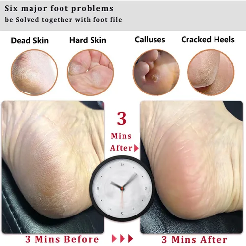 Vista 3 de LEKESI - Lima de piedra pómez para retirar callosidades y piel muerta de los pies, herramienta para exfoliar y masajear los pies, se usa con pies