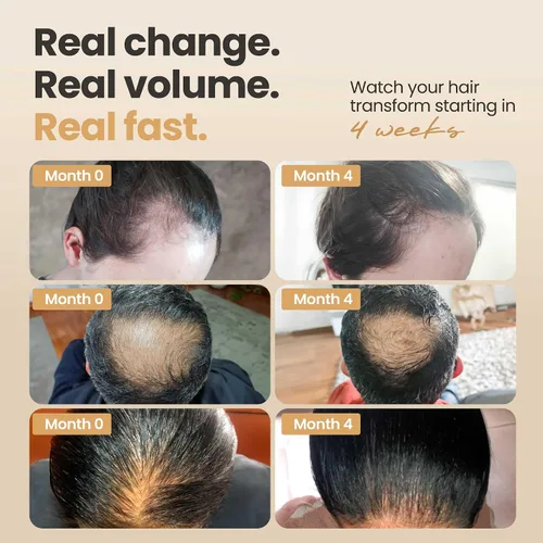 Vista 3 de Vitasei Hair Booster - Suero revitalizante para el cabello con capilia longa, células madre de oliva silvestre y arginina, tónico capilar
