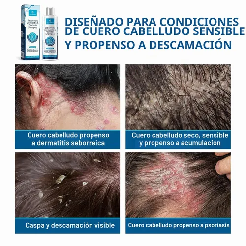 Vista 3 de Roycederm Champú de Dermatitis seborreica y psoriasis con ácido salicílico