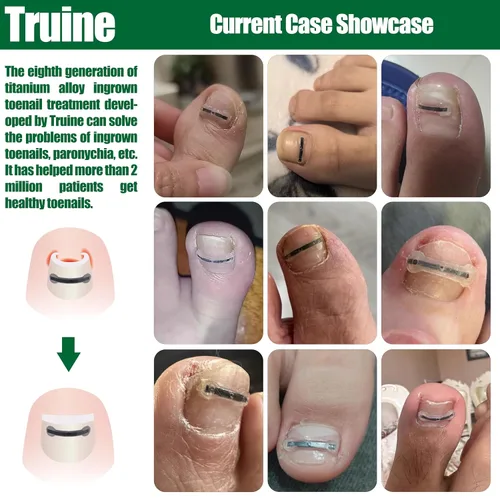 Vista 3 de Corrector de uñas encarnadas de titanio, herramientas de reparación de uñas, tratamiento de uñas encarnadas, adecuado para la mayoría
