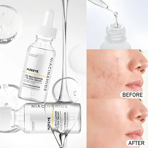 Vista 7 de Suero facial de niacinamida 10% + zinc 1% para niñas y mujeres, suero hidratante de niacinamida para el acné, enrojecimiento.
