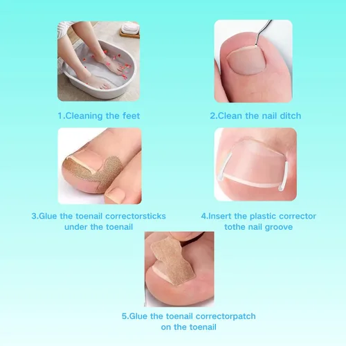Vista 4 de Juego de corrector de uñas encarnadas con parche de corrección de uñas curvas, kit de eliminación de uñas mejorado, herramientas de pedicura