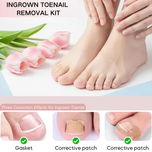 Vista 5 de Juego de corrector de uñas encarnadas con tiras correctoras, juego de herramientas profesionales de pedicura para uñas encarnadas con lima