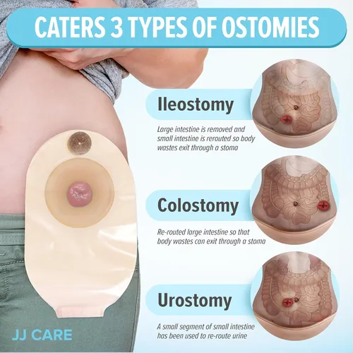 Vista 2 de Bolsas de colostomía 20 piezas, bolsas de ostomía de una pieza, suministro de ostomía sin desorden