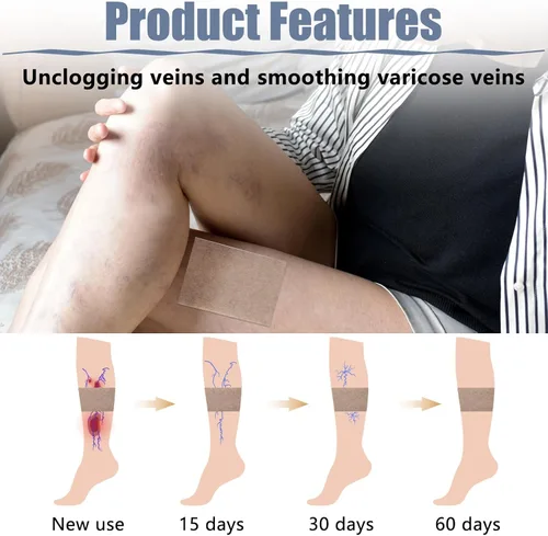 Vista 4 de 36 parches para venas varicosas, tratamiento natural de alivio para piernas, araña, varices, fortalece la salud capilar y mejora la circulación