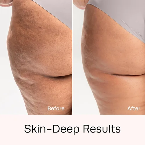 Vista 5 de Hot Vita Tónico de retinol – Aceite roll-on con retinol para una piel más suave y firme – Cuidado específico para vientre, muslos, brazos y piernas