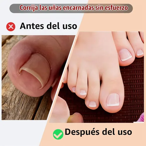Vista 2 de Kit corrector de uñas encarnadas – tiras, parche, lima y levantador Breathable Ingrown Toenail Strips and curved toenail patch for home pedicure