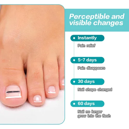 Vista 7 de Herramienta de tratamiento de uñas encarnadas de aleación de titanio, kit de eliminación de uñas de los pies para reparación de uñas curvas, 10