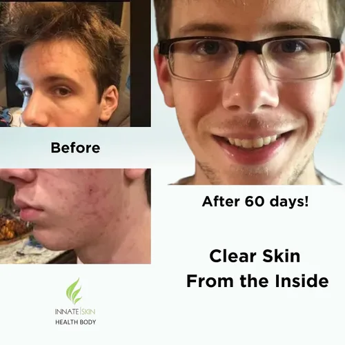 Vista 4 de Clear Skin - Paquete de vitaminas para el acné 20 antioxidantes, botánicos, minerales y vitaminas Pastillas hormonales y quísticas para el acné
