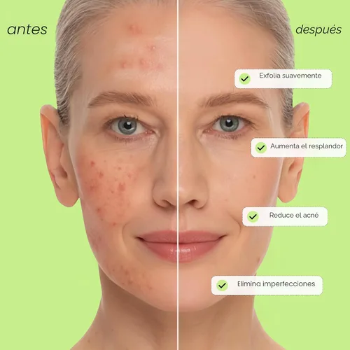 Vista 4 de MAREE Tónico Exfoliante con Ácido Salicílico – Exfoliante Facial AHA BHA & Limpiador de Poros – Exfoliante Líquido BHA para Cuidado de Sebum y Piel