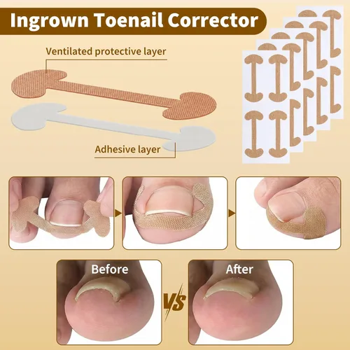 Vista 6 de Juego de corrector de uñas encarnadas con tiras correctoras y lima sin dolor, kit profesional de eliminación de uñas encarnadas con herramienta