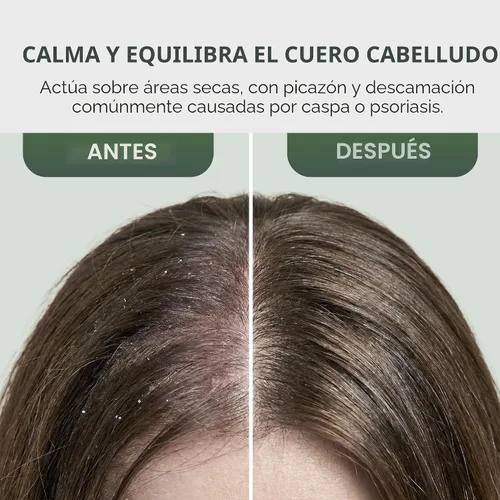 Vista 5 de Spray acondicionador sin enjuague – Tratamiento del cuero cabelludo del árbol de té (paquete de 2) – Anti-caspa, alivio del cuero cabelludo seco