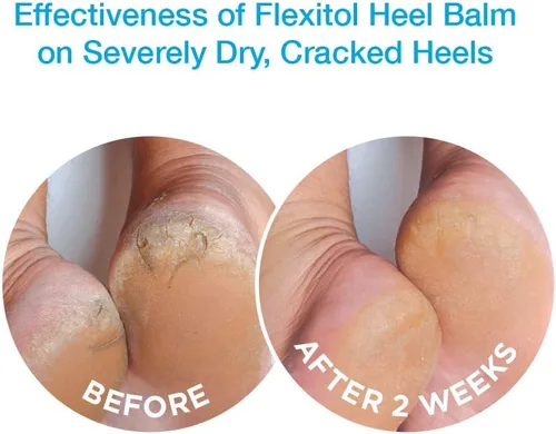 Vista 3 de Flexitol Tubo de bálsamo para el talón de 4 onzas (paquete de 2), rica crema hidratante y exfoliante para pies. Alivio rápido de la piel áspera