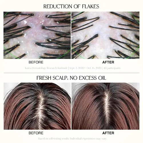 Vista 5 de Champú reequilibrante con solución de cuero cabelludo, limpieza refrescante y refrescante para cuero cabelludo normal a graso, dermatológicamente