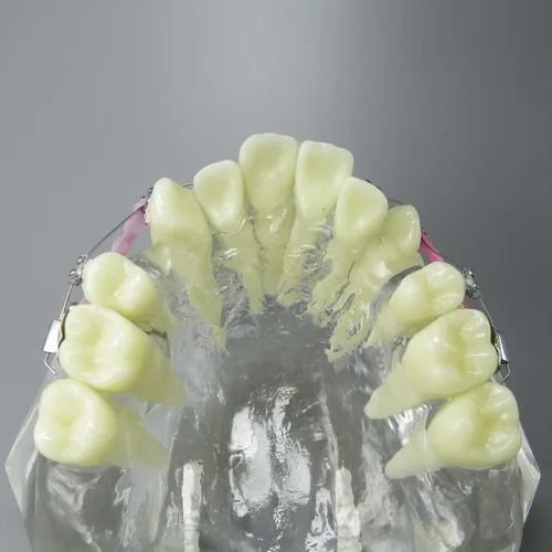 Vista 6 de Modelo dental de los dientes del tratamiento de ortodoncia de la maloclusión con los soportes del metal Alambres Cadenas y aros coloridos