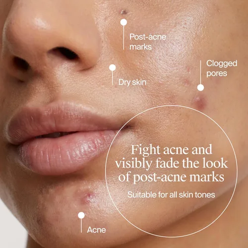 Vista 3 de Neutrogena Hidratante de gel para acné uniformemente transparente con ácido salicílico y N-acetil glucosamina, hidratante facial ligero y no grasoso