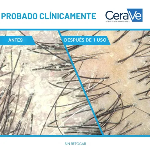 Vista 3 de CeraVe Acondicionador hidratante anticaspa, tratamiento de caspa de zinc piritiona al 0,5% con ceramidas, ácido hialurónico y niacinamida, ayuda a