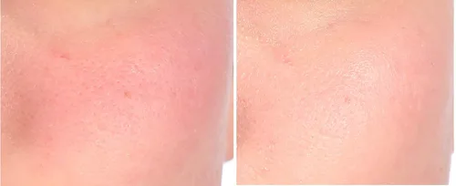 Vista 5 de Nakery Tratamiento de reparación intensiva para aliviar el eccema crema calmante para rostro y cuerpo 2% de avena coloidal Alivio inmediato