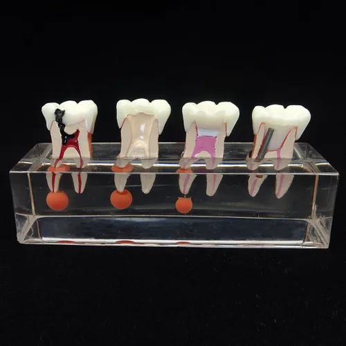 Vista 2 de Modelo de dientes dentales Modelo de tratamiento endodóntico de 4 etapas para estudiar y enseñar..