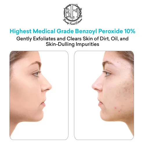 Vista 3 de Tratamiento de lavado facial para acné con peróxido de benzoilo – Combate las imperfecciones del acné al contacto para brotes quísticos, piel grasa