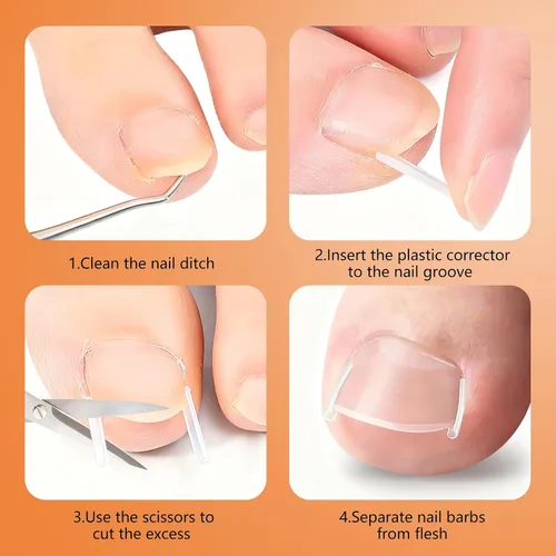 Vista 6 de Juego de corrector de uñas encarnadas con tiras correctoras, juego profesional de herramientas de pedicura para uñas encarnadas para hombres