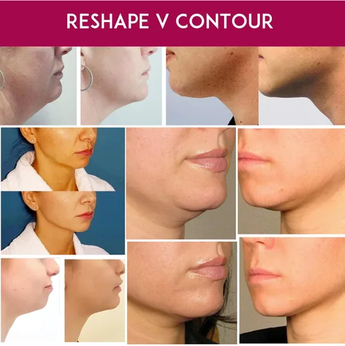 Vista 4 de Máscara facial – Jawline Lift Enhancer Face Reafirming Skin Tightening Skin Up Funciona para la línea V Máscara de cuello para mujeres y hombres