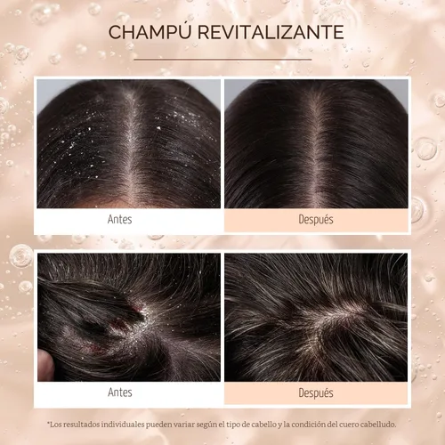 Vista 7 de Champú antifúngico para mujeres Tratamiento de foliculitis: champú para dermatitis seborreica para alivio del cuero cabelludo escamoso