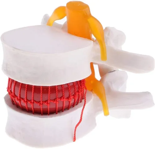 Vista 2 de Modelo de columna vertebral de hernia de disco lumbar, aumento 1.5X anatómica hernia lumbar humana disco intervertebral para enseñanza escolar
