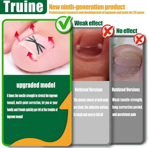 Vista 2 de Corrector de uñas encarnadas de titanio mejorado, tratamiento de uñas encarnadas, adecuado para uñas curvas, kit de eliminación de uñas encarnadas