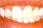 Vista 3 de D.I.Y) 10 thermo-molding "hervir y Bite Boca Bandejas por instantánea blanco Sonrisa mayorista