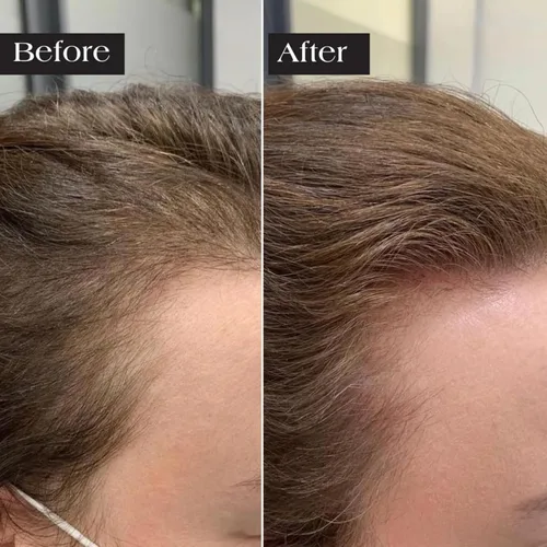 Vista 10 de Kit de renovación de cabello con micro infusión, suero para el cabello con ácido hialurónico, péptido y ampollas de suero botánico