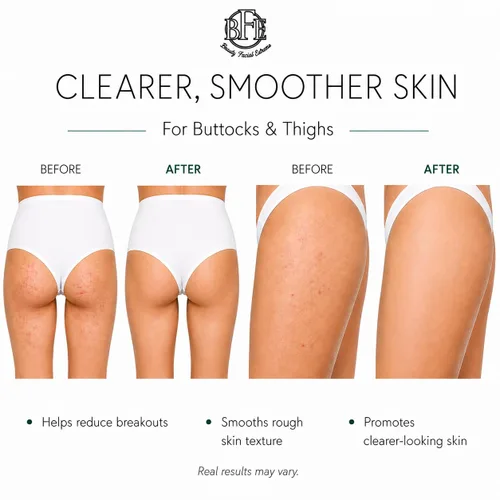 Vista 3 de Crema para el tratamiento del acné en los glúteos, brotes claros, espinillas, manchas oscuras y pelos encarnados para glúteos y muslos, suaviza