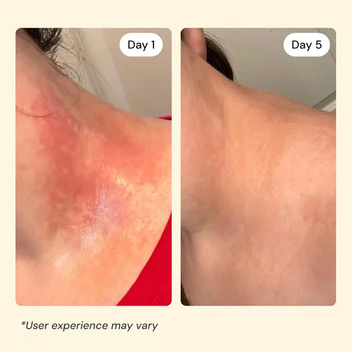Vista 3 de MyMagicHealer Universal Flare Care Sin aceite esencial Alivio para erupciones, eczema, psoriasis, hidradenitis supurativa, impétigo, dermatitis