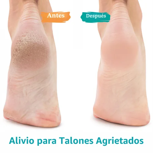 Vista 2 de GILDEN TREE Gel de urea 42 % para pies, máxima fuerza, suaviza los callos del talón agrietado y las uñas gruesas de los pies