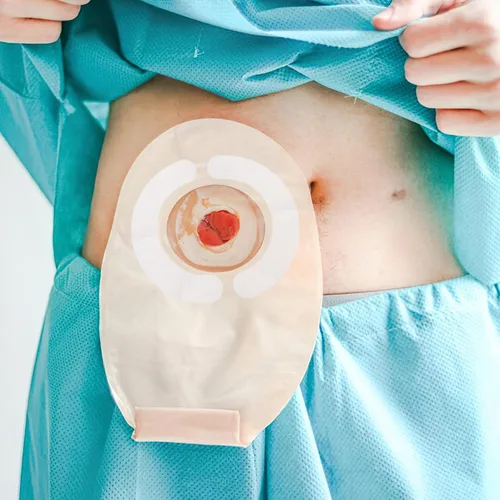 Vista 8 de 40pcs Skin Barrier Strip Elastic Ostomy Barrier Tape Waterproof Hydrocolloid Extenders Pressure Sensitive Sticker ostomy Supplies colostomy Supplies