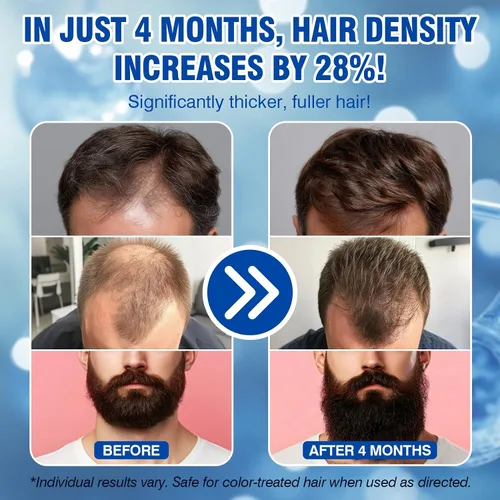 Vista 2 de 5% de minoxidil para hombres en aerosol para el crecimiento del cabello, suero tópico de minoxidil para barba, regeneración del cabello más grueso