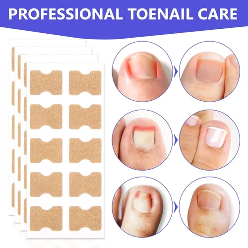 Vista 4 de Parche corrector de uñas encarnadas, 100 tiras correctoras de uñas encarnadas, parches de corrección de uñas de los pies, herramienta de tratamiento