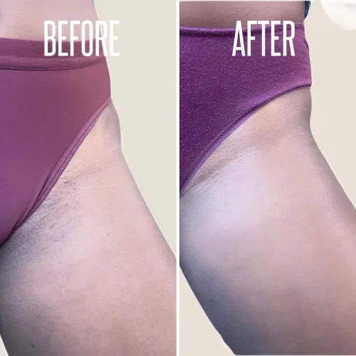 Vista 8 de El gel aclarador de la piel íntima para el cuerpo y el área del bikini y el suero eliminador de vello encarnado proporciona la combinación más