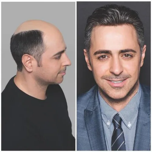 Vista 5 de 1B20 unidades de cabello gris Toupee para hombres piezas para hombre NLW sistema de reemplazo de heredero humano europeo para hombres 10x8 "toupee