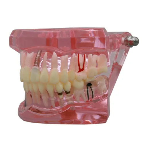 Vista 5 de Demostración oral del puente de la patología del color rosado de los dientes de Typodont de la restauración del implante dental M2001