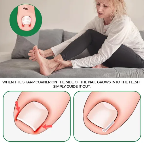 Vista 2 de Kit de eliminación de uñas encarnadas, tiras alisadoras de uñas sin dolor, 60 piezas, levantador de uñas y tijeras pequeñas, juego de corrector
