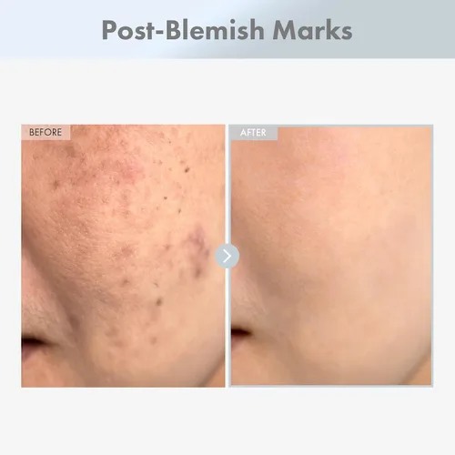 Vista 3 de TOSOWOONG Suero facial de niacinamida al 15%, niacinamida de 150,100 ppm, ácido tranexámico, corrector de manchas oscuras, piel de vidrio, tez