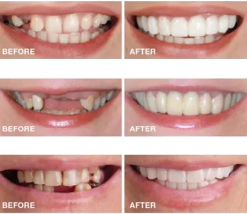 Vista 2 de 2 pares, hermosa sonrisa, ajustable temporalmente para hombres y mujeres