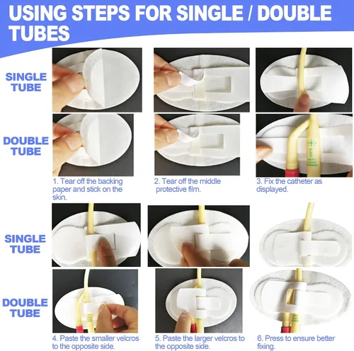 Vista 6 de Foley - Dispositivo de estabilización de catéter (paquete de 5) – Sujeta el tubo individual/doble, el tubo G y el tubo de alimentación en su lugar