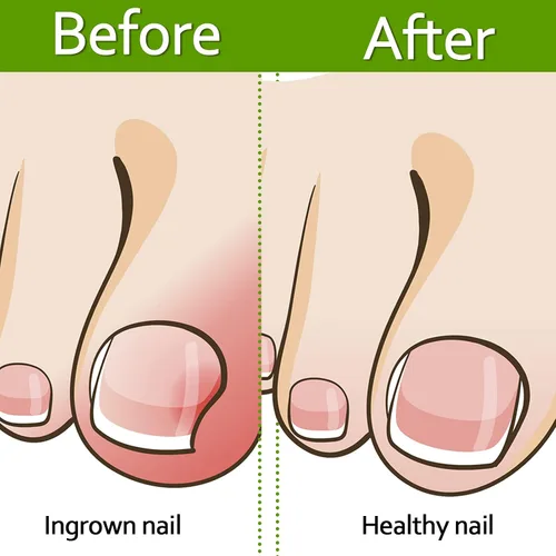 Vista 5 de 100 tiras correctoras de uñas encarnadas, parches de corrección de uñas de los pies, parches curvos para enderezar las uñas de los pies, clips