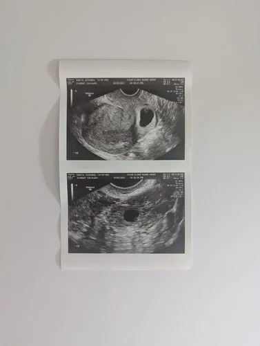 Vista 3 de Broma de ultrasonido 2D personalizada falsa con dos fotos conectadas B&W