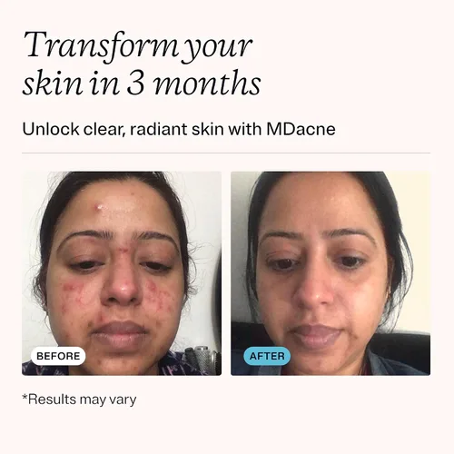 Vista 3 de MDacne Ácido salicílico 2.0% – Crema de tratamiento para el acné, exfoliante facial que desobstruye los poros, evita manchas, puntos negros, arrugas
